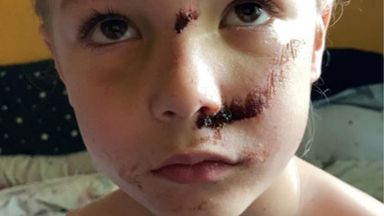 Six-year-old Jamie Smith suffered a fractured skull after being hit by an e-scooter rider. Pic: Leicestershire Police